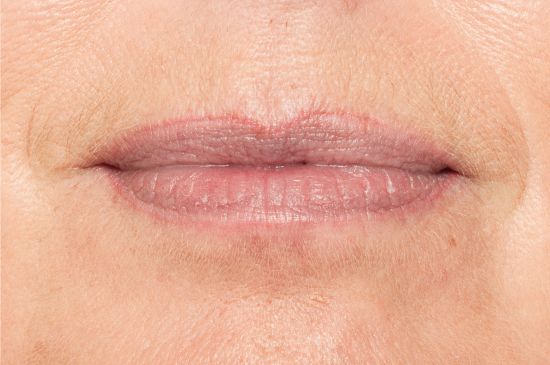 auffrischung-lippen-vorher-permanent-make-up