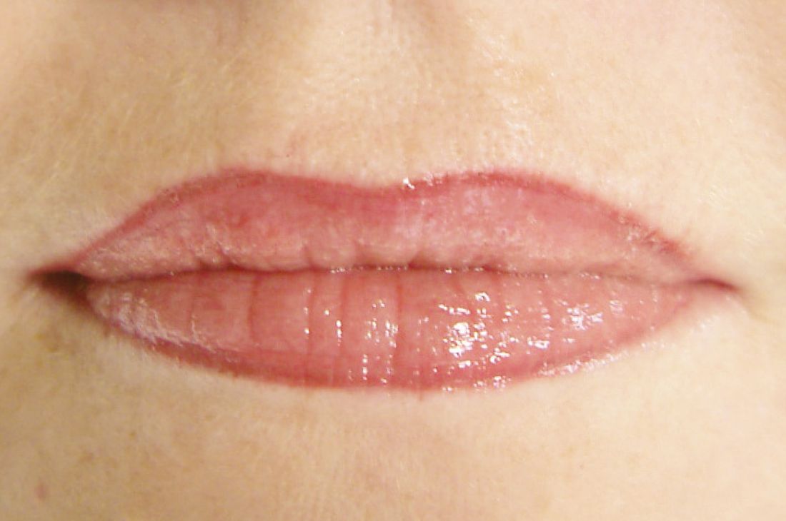 begleiterscheinung-lippen-dunkel-permanent-make-up