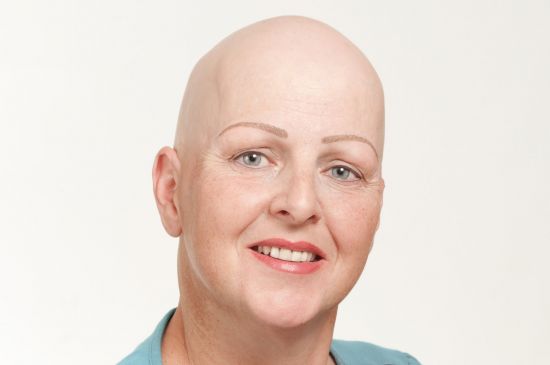 haarausfall-alopecia-areata-nachher-mit-permanent-make-up