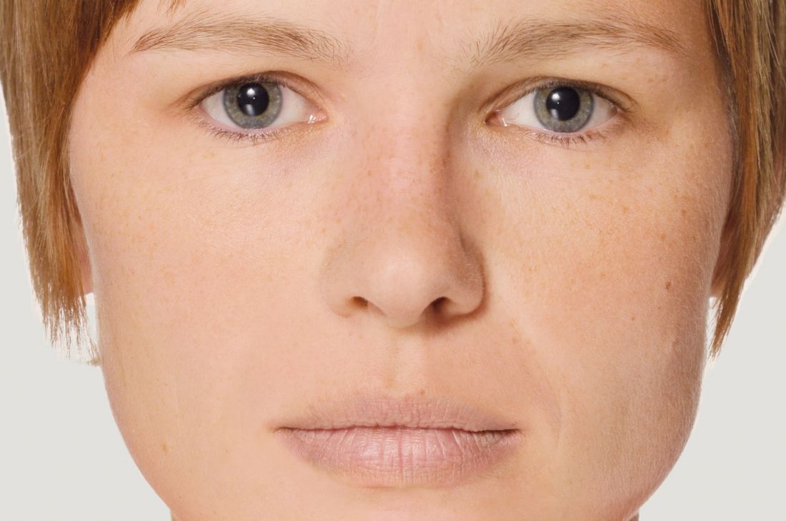 lippen-entstehen-vorher-gesamteindruck-zu-blasse-lippen