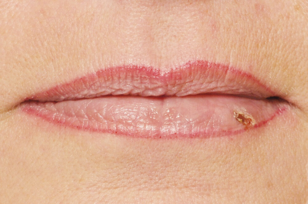 begleiterscheinung-lippen-herpes-permanent-make-up