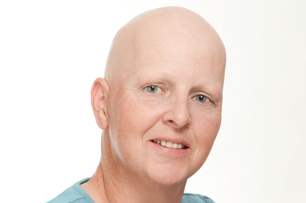 haarausfall-alopecia-areata-vorher-ohne-permanent-make-up