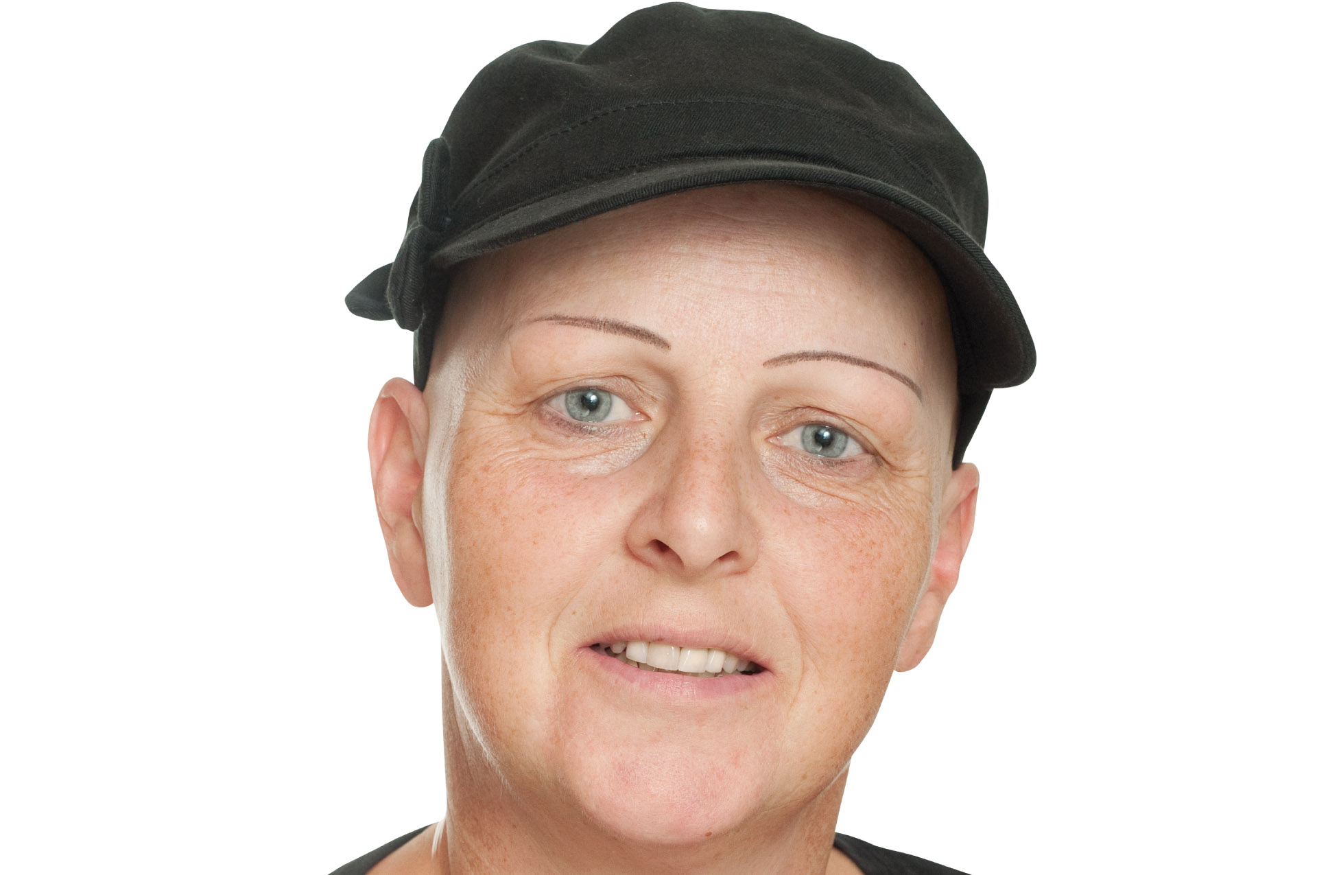 haarausfall-alopecia-areata-vorher-permanent-make-up.mit-hut-brauenstift