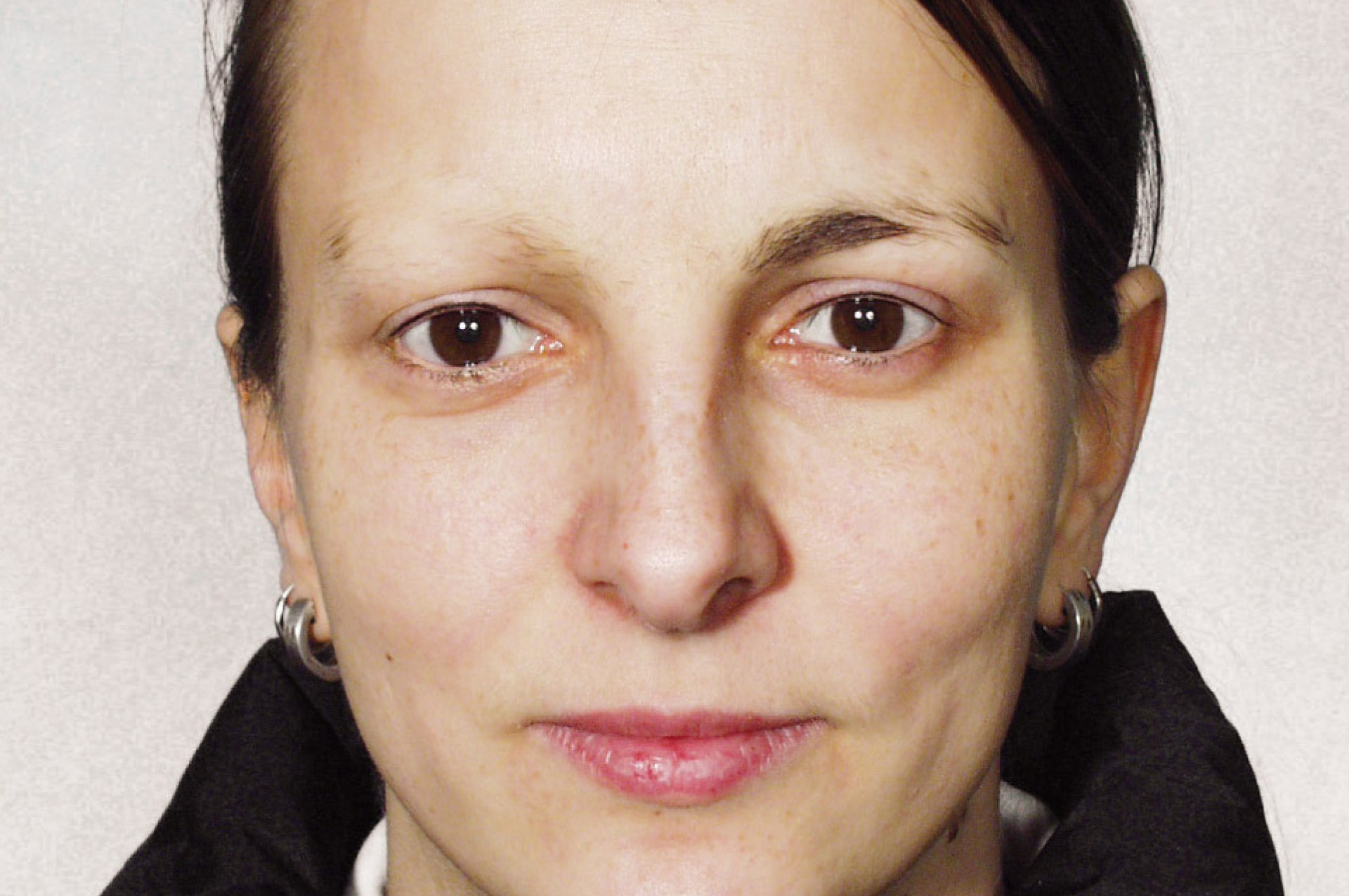 haarausfall-teiweise-vorher-permanent-make-up