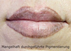 images-stories-pictures-verzeichnung-lippenkotur-ungleich-und-zuviel_230x164_1