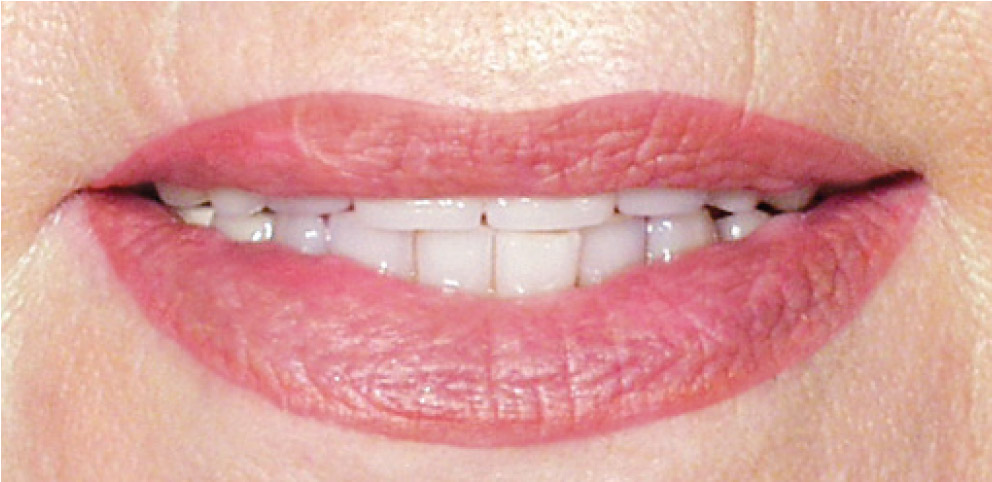 narben-lippen-nachher-permanent-make-up
